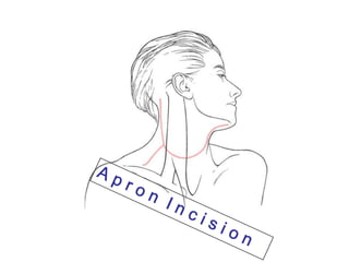 A p r o n  I n c i s i o n