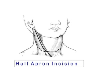 H a l f  A p r o n  I n c i s i o n
