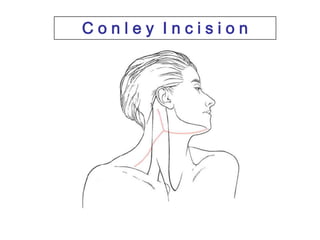 C o n l e y  I n c i s i o n