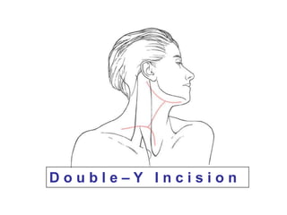 D o u b l e – Y   I n c i s i o n