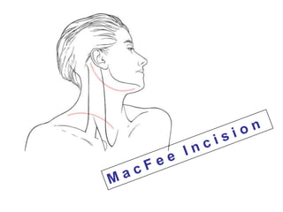 M a c F e e  I n c i s i o n