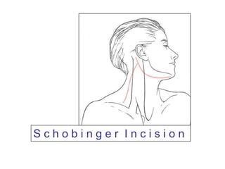 S c h o b i n g e rI n c i s i o n