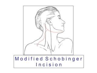 M o d i f i e d  S c h o b i n g e rI n c i s i o n