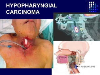 HYPOPHARYNGIAL
CARCINOMA
 