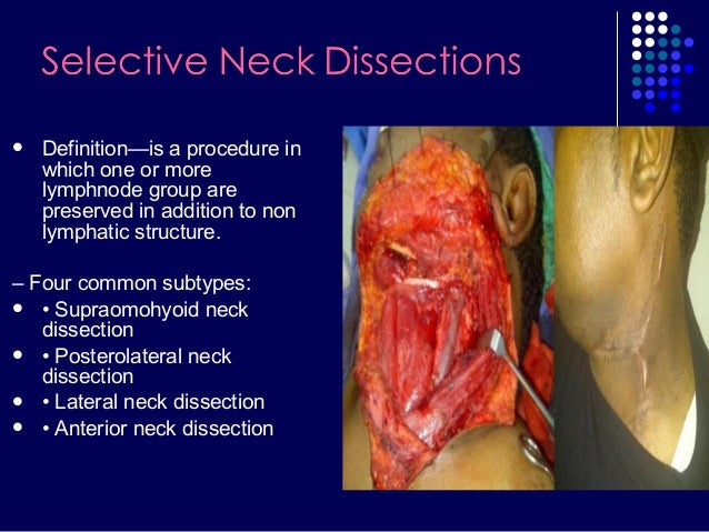 Neck Dissection Overview