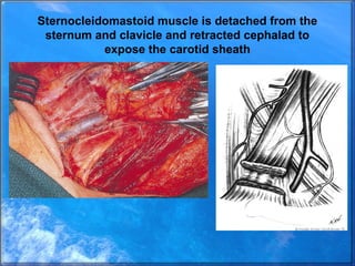 Sternocleidomastoid muscle is detached from the
sternum and clavicle and retracted cephalad to
expose the carotid sheath
 