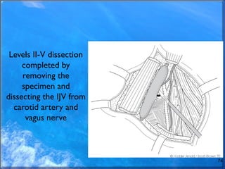 Levels II-V dissection
completed by
removing the
specimen and
dissecting the IJV from
carotid artery and
vagus nerve
74
 