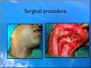 Surgical procedure
 