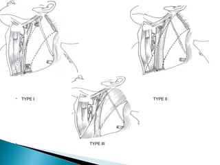  TYPE I TYPE II
 TYPE III
 