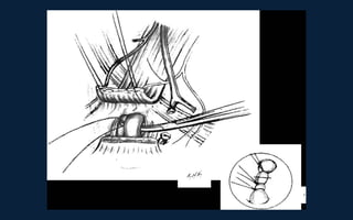 Neck Dissection Incision Apron Neck dissection | PPT