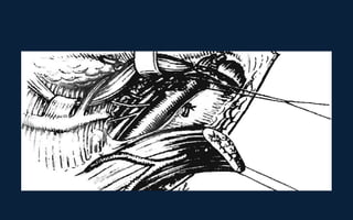 Neck Dissection Incision Apron Neck dissection | PPT