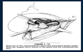 Neck Dissection Incision Apron Neck dissection | PPT