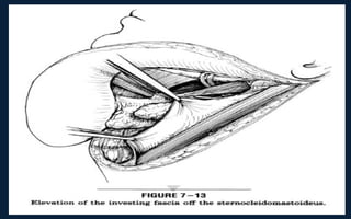 Neck Dissection Incision Apron Neck dissection | PPT