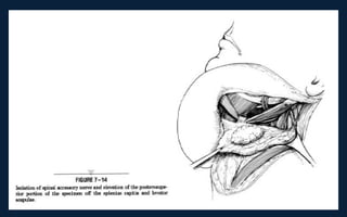 Neck Dissection Incision Apron Neck dissection | PPT