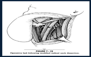 Neck Dissection Incision Apron Neck dissection | PPT