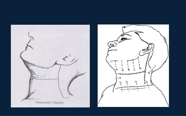 Neck dissection