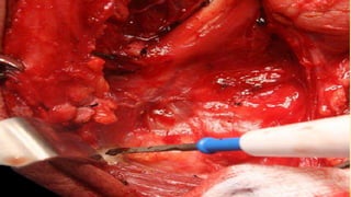 Neck dissection | PPTX