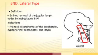 SND: Lateral Type
• Definition
– En bloc removal of the jugular lymph
nodes including Levels II-IV.
Indications
– N0 neck ...