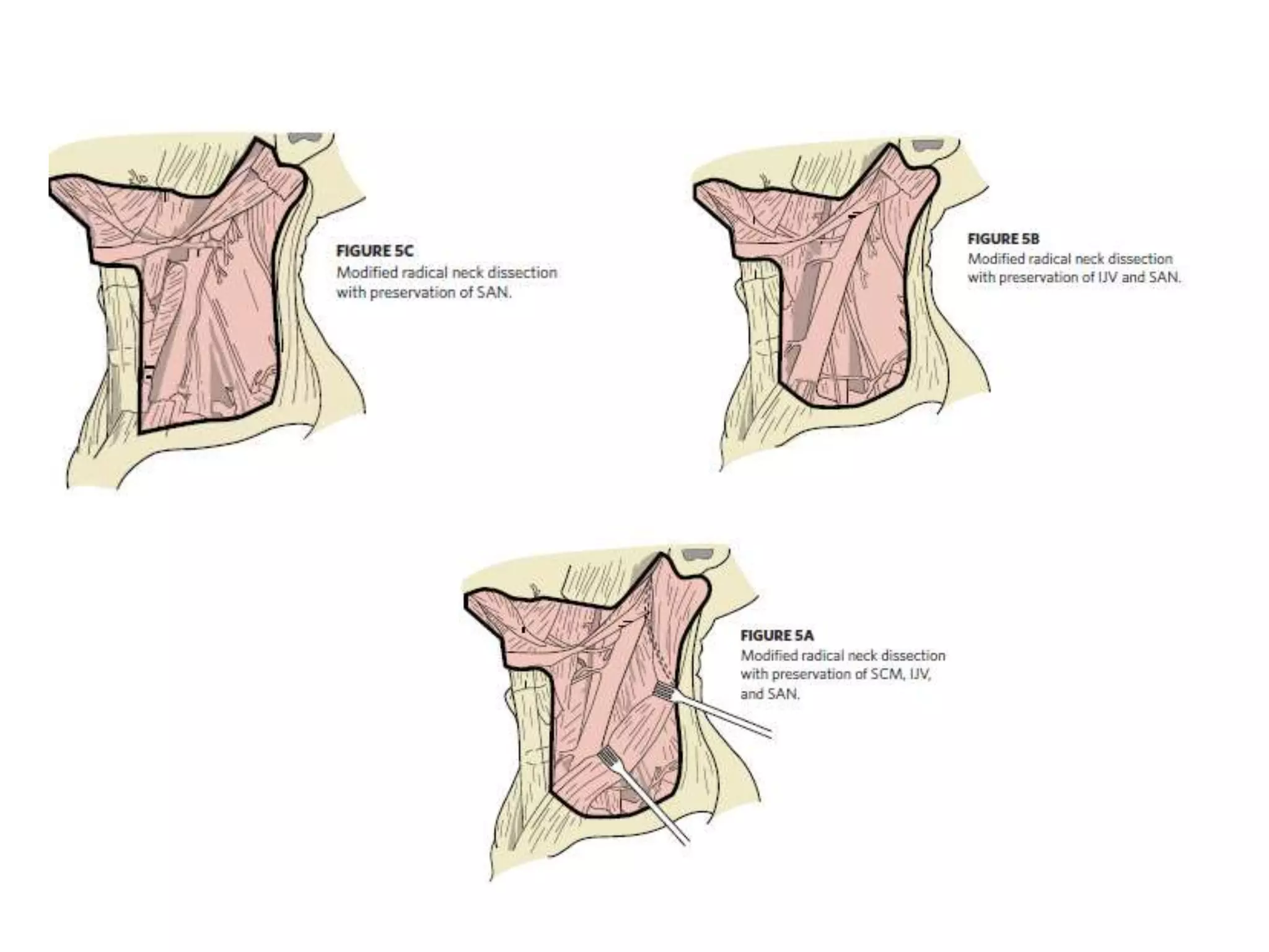 Dissected Neck Neck dissection | PPTX
