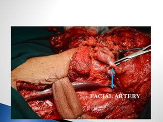 FACIAL ARTERY
 