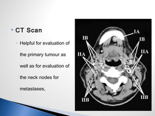  CT Scan
◦ Helpful for evaluation of
the primary tumour as
well as for evaluation of
the neck nodes for
metastases,
 