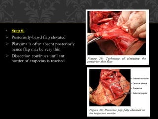 Neck dissection | PPTX