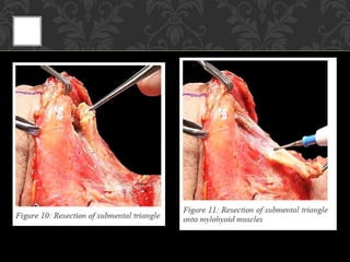 • Step 3:
 fascia along lateral aspect of
digastric divided
 EJV divided
 post belly of digastric exposed along
its ent...