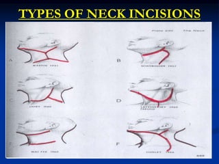 TYPES OF NECK INCISIONS
 