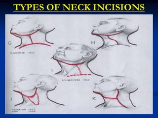 TYPES OF NECK INCISIONS
 