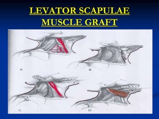 LEVATOR SCAPULAE
MUSCLE GRAFT
 