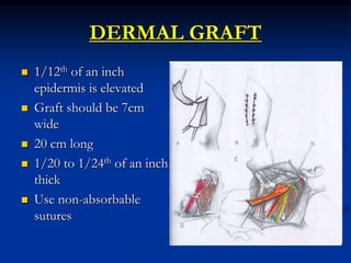 DERMAL GRAFT
 1/12th of an inch
epidermis is elevated
 Graft should be 7cm
wide
 20 cm long
 1/20 to 1/24th of an inch
thick
 Use non-absorbable
sutures
 