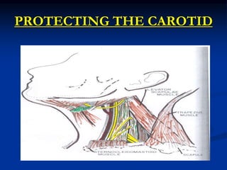 PROTECTING THE CAROTID
 