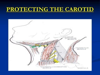 PROTECTING THE CAROTID
 