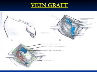 VEIN GRAFT
 