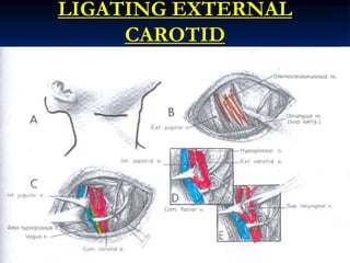 LIGATING EXTERNAL
CAROTID
 