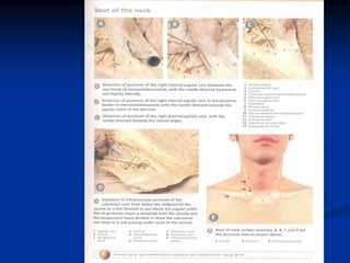 MARTIN INCISION
 Upper incision -
submental area to tip of
mastoid
 Lower incision -
suprasternal notch to
4cm above cla...