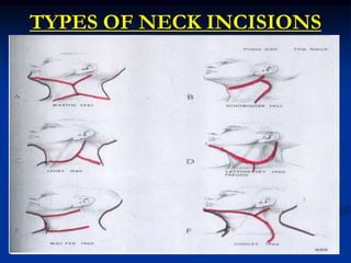 Neck dissection | PPT