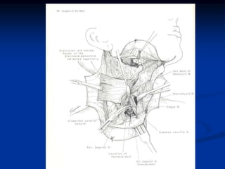 SUBMANDIBULAR GLAND
 The submandibular gland is pulled
down exposing the lingual nerve
 Whartin’s duct: This is resected...