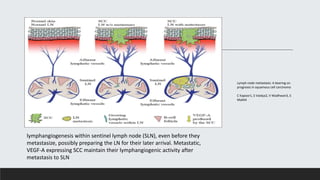lymphangiogenesis within sentinel lymph node (SLN), even before they
metastasize, possibly preparing the LN for their later arrival. Metastatic,
VEGF-A expressing SCC maintain their lymphangiogenic activity after
metastasis to SLN
Lymph node metastasis: A bearing on
prognosis in squamous cell carcinoma
C Kapoor1, S Vaidya2, V Wadhwan3, S
Malik4
 