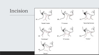 Incision
 