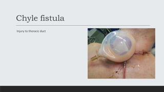 Chyle fistula
Injury to thoracic duct
 