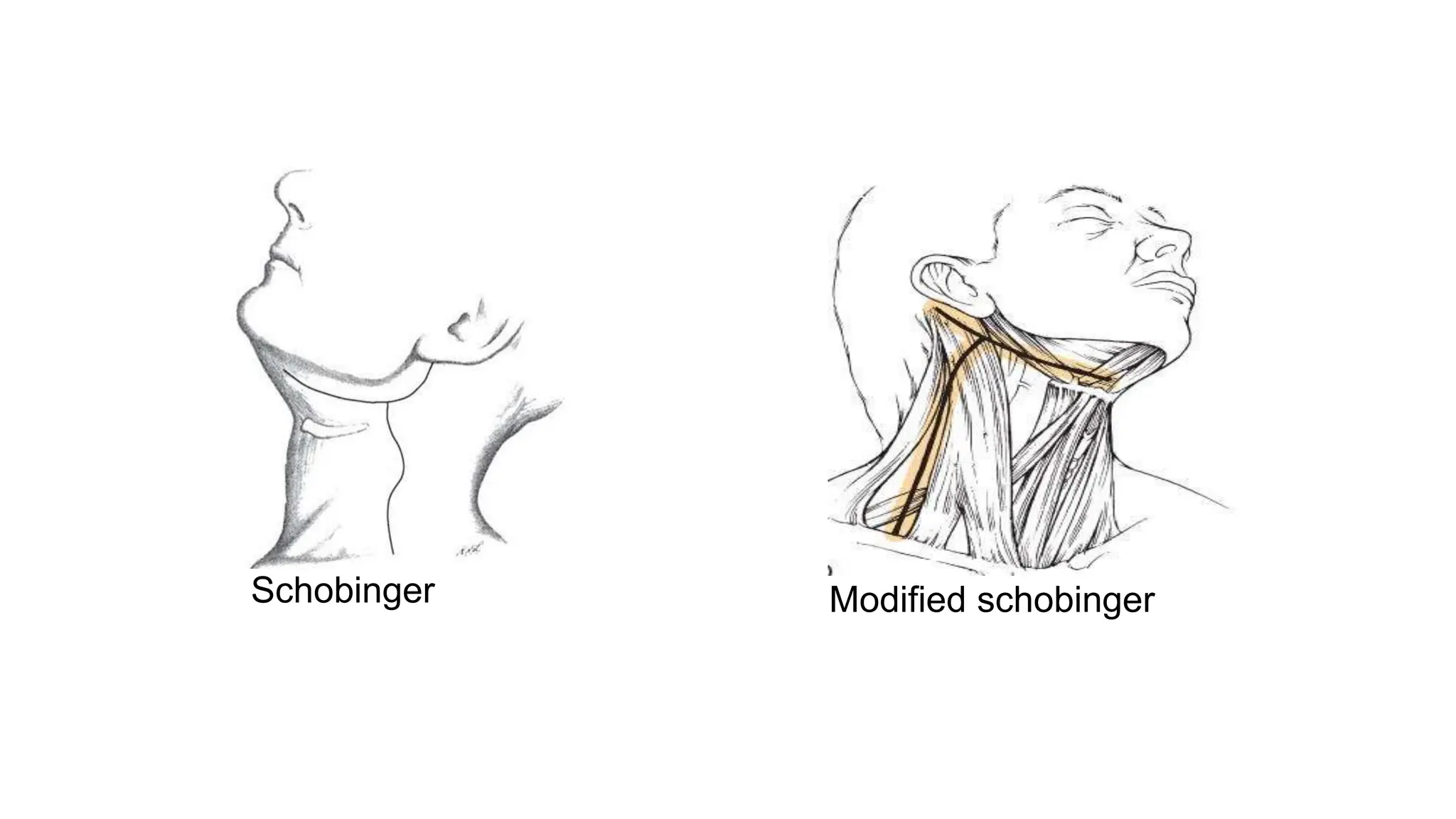 Neck Dissection Head Neck oncoSurgery.pptx