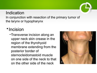 neck dissection mrnd and rnd in head and neck cancer.pptx