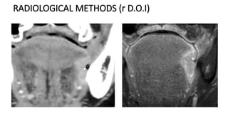 Neck Dissection Rcpa NECK DISSECTION current protocol/management of neck .pptx