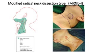 Neck Dissection Rcpa NECK DISSECTION current protocol/management of neck .pptx