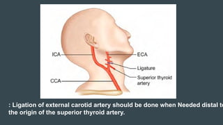 Neck Dissection Rcpa Neck Dissection and different important triangles of neck for ...