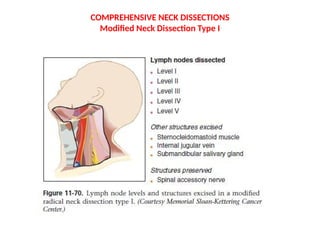 Dissection Neck NECK DISSECTION-final (1).pptx Oral squamous cell carcinoma | PPTX