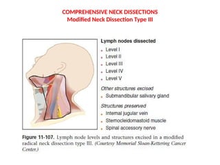 Neck Dissection Rcpa NECK DISSECTION-final (1).pptx Oral squamous cell carcinoma | PPTX