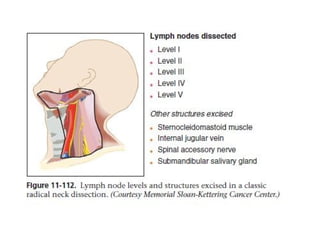 Vii Neck Dissection NECK DISSECTION-final (1).pptx Oral squamous cell carcinoma | PPTX
