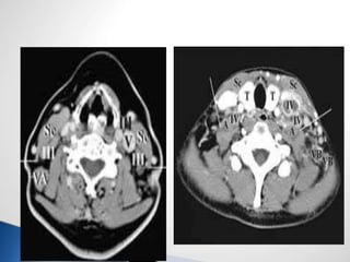 Neck dissection dr inder | PPTX